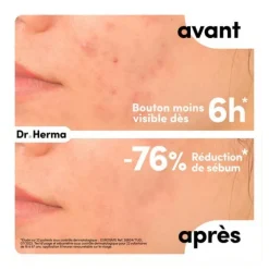 Dr Herma Patch anti boutons format Large
