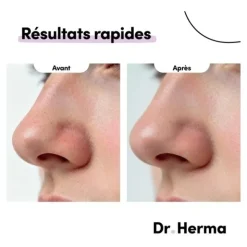 Dr Herma Patch anti points noirs pour le nez