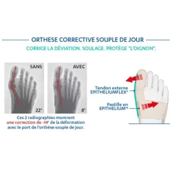 Epitact Epithelium Flex orthèse hallux valgus oignon