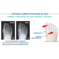 Epitact Thermoformable orthèse nuit hallux valgus