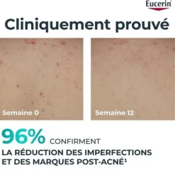 Eucerin DermoPure Crème Corps Correctrice