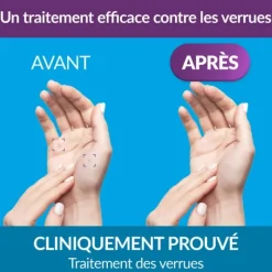 Excilor Verrue traitement par cryothérapie