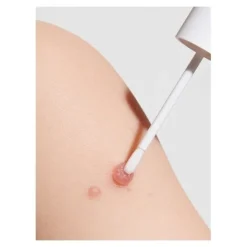 Molusderm Traitement Molluscum Contagiosum