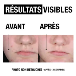 Neutrogena Anti-boutons+ Sérum visage