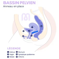 Pessaire Anneau Dr Arabin