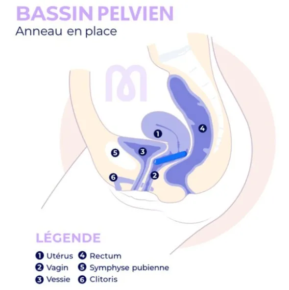 Pessaire Anneau Dr Arabin