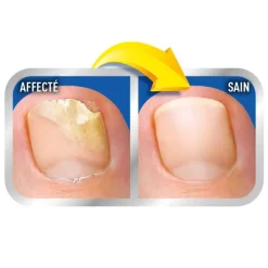 Scholl solution mycoses des ongles