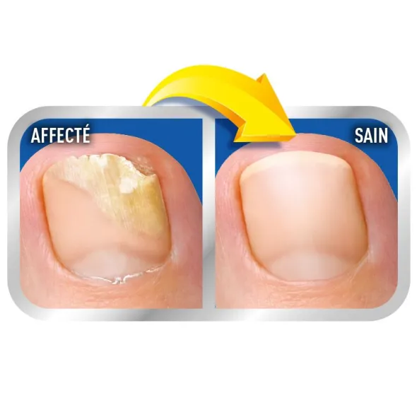 Scholl solution mycoses des ongles