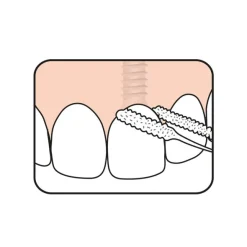 TePe Fil dentaire bridge et implant